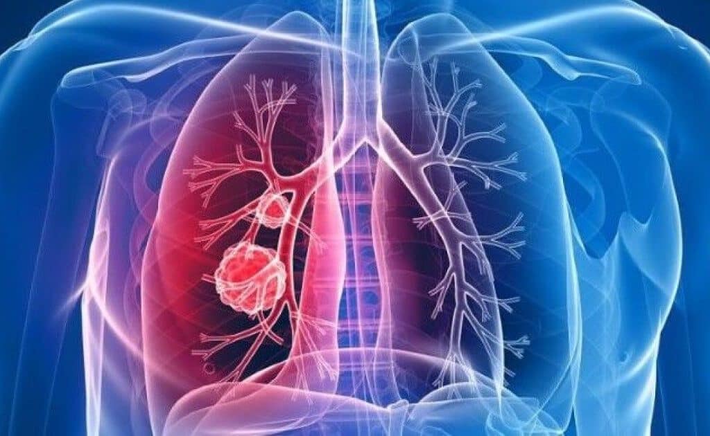lungcancer from cig poisoning