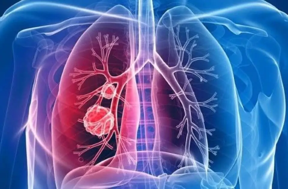 lungcancer from cig poisoning